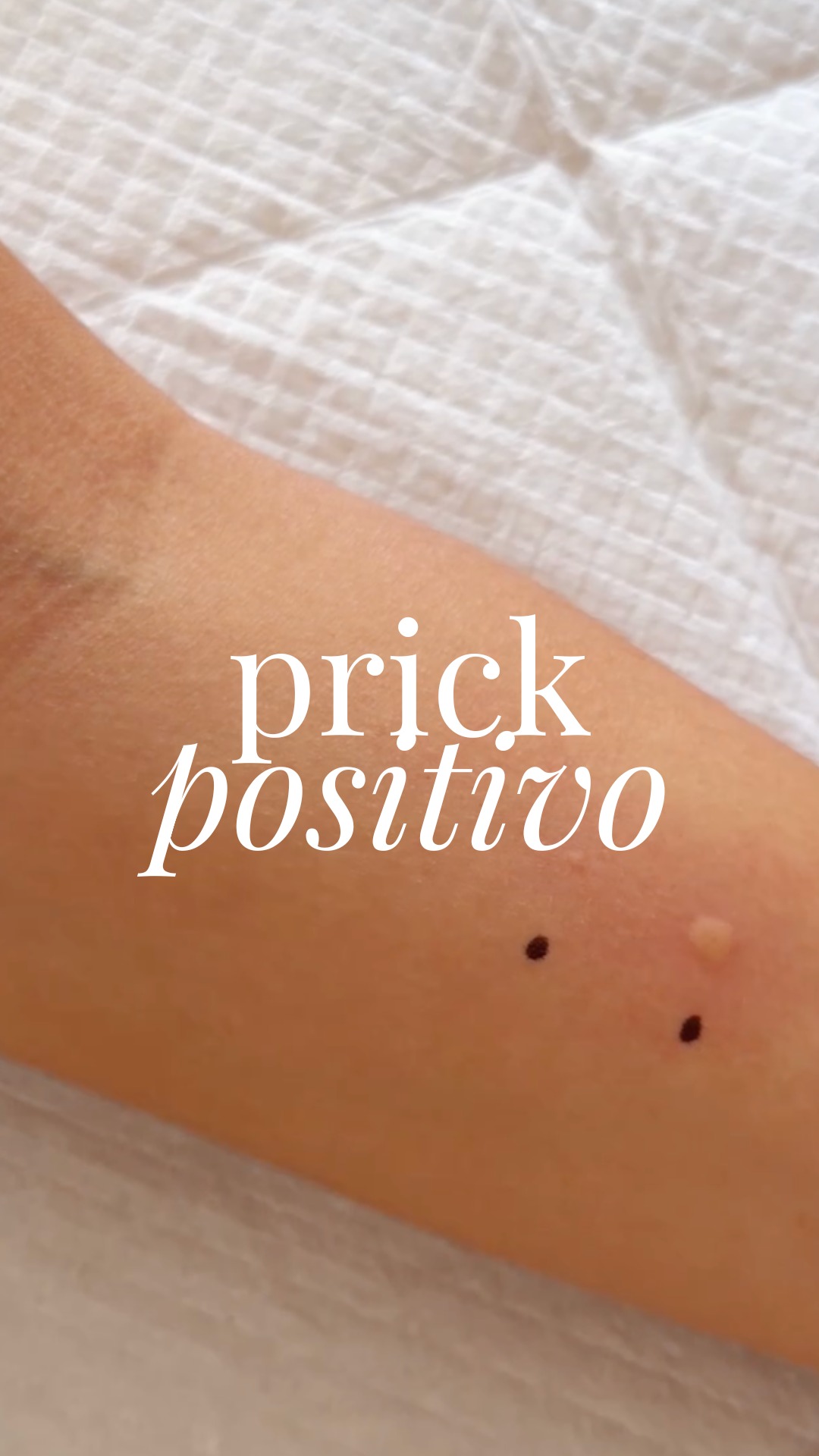 🩹 Un prick test positivo no siempre significa que tengas alergia.
Esta es una de las dudas que más pueden surgir después de realizar una prueba de alergia.

Un resultado positivo indica una sensibilización frente a un determinado alérgeno, pero para hablar de alergia es necesario relacionarlo con los síntomas y con la historia clínica de cada paciente.

🧬 Por eso, una prueba nunca debería interpretarse de forma aislada.
👩🏻‍⚕️ El diagnóstico de una alergia va mucho más allá de un resultado positivo.
¿Conocías esta diferencia?
.
🩹 Un prick test positiu no sempre vol dir que tinguis al·lèrgia.
Aquesta és una de les preguntes que més poden sorgir després de fer-se una prova d’al·lèrgia.

Un resultat positiu indica una sensibilització davant d’un determinat al·lergen, però per parlar d’al·lèrgia cal relacionar-lo amb els símptomes i amb la història clínica de cada pacient.

🧬 Per això, una prova mai s’hauria d’interpretar de manera aïllada.
👩🏻‍⚕️ El diagnòstic d’una al·lèrgia va molt més enllà d’un resultat positiu.
Coneixies aquesta diferència?
.
#PrickTest #Alergia #DiagnosticoDeAlergia #Alergología #Sensibilización #Salud #PaulaRibo #Granollers