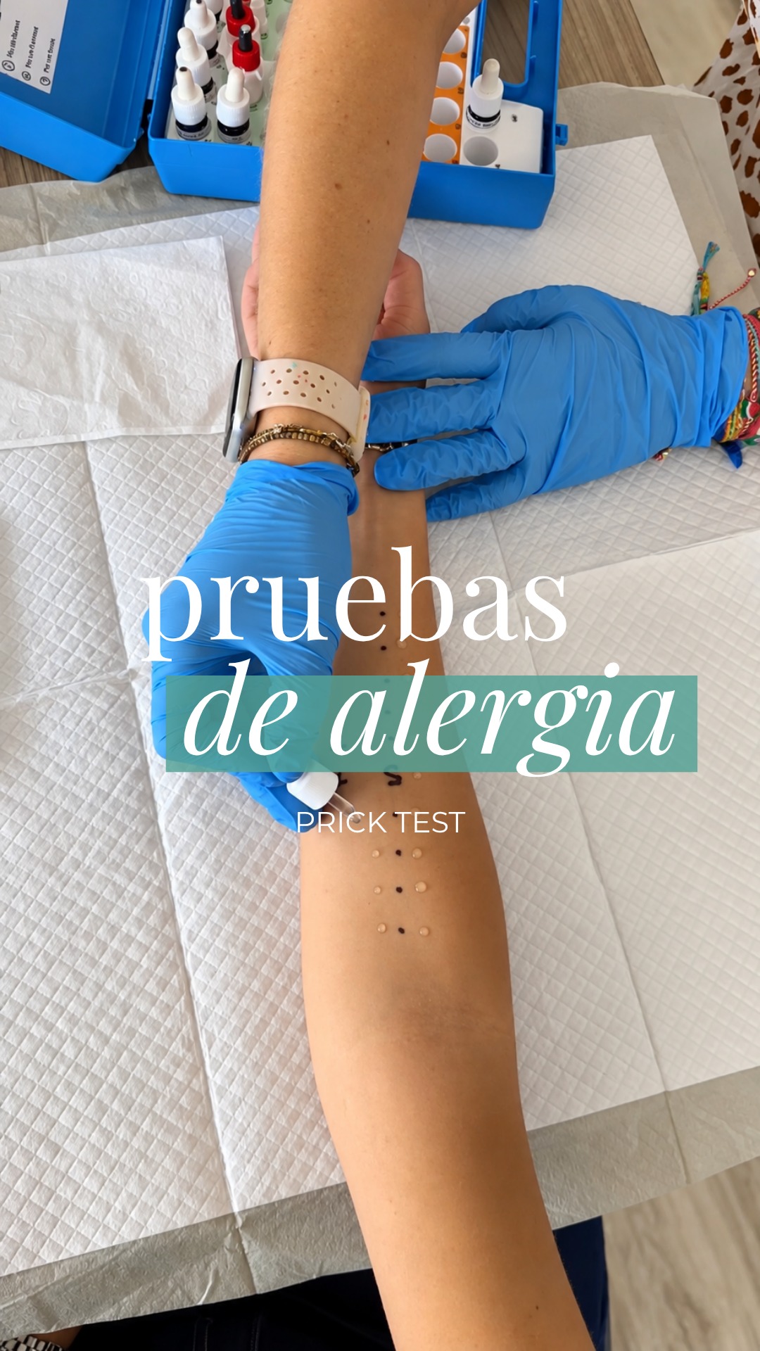 ¿Cómo se hacen las pruebas de alergia? 🩺

Seguro que has visto alguna vez estas pequeñas gotitas sobre la piel, pero… ¿sabes qué hacemos exactamente?

En el prick test colocamos pequeñas gotas de diferentes extractos alergénicos sobre la piel y realizamos una pequeña punción superficial a través de cada una de ellas.

⏱️ Después de unos 15-20 minutos, observamos y medimos la reacción de la piel para comprobar si existe sensibilización frente a alguno de los alérgenos estudiados. 

🌿 Pólenes, ácaros, alimentos, animales… Las sustancias que se estudian dependen de los síntomas y de la historia clínica de cada paciente.

Y algo muy importante: un resultado positivo no significa automáticamente que tengas una alergia. Las pruebas deben interpretarse siempre junto con tus síntomas y tu historia clínica.

👩🏻‍⚕️ Por eso, el estudio de una alergia va mucho más allá de un simple test.
¿Conocías cómo se realizan estas pruebas? 👇🏻
.
Com es fan les proves d’al·lèrgia? 🩺

Segur que alguna vegada has vist aquestes petites gotes sobre la pell, però… saps què fem exactament?

En el prick test col·loquem petites gotes de diferents extractes al·lergènics sobre la pell i fem una petita punció superficial a través de cadascuna.

⏱️ Després d’uns 15-20 minuts, observem i mesurem la reacció de la pell per comprovar si hi ha sensibilització davant d’algun dels al·lèrgens estudiats.

🌿 Pol·lens, àcars, aliments, animals… Les substàncies que s’estudien depenen dels símptomes i de la història clínica de cada pacient.

I una cosa molt important: un resultat positiu no significa automàticament que tinguis una al·lèrgia. Les proves sempre s’han d’interpretar juntament amb els teus símptomes i la teva història clínica.

👩🏻‍⚕️ Per això, l’estudi d’una al·lèrgia va molt més enllà d’un simple test.
Coneixies com es fan aquestes proves? 👇🏻
.
#PrickTest #PruebasDeAlergia #Alergia #Alergología #DiagnósticoAlergológico #PaulaRibo #Granollers